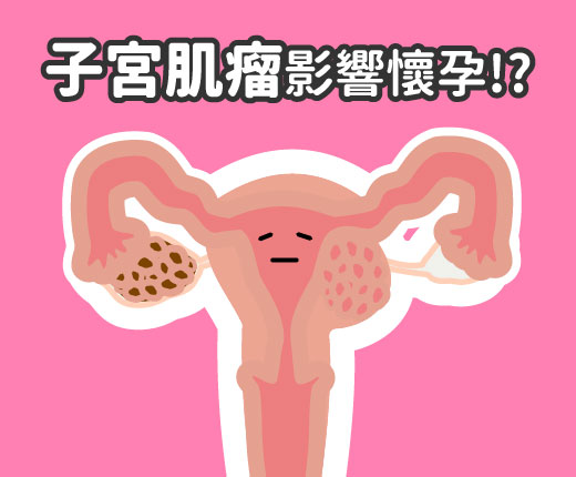 子宮肌瘤,子宮肌瘤懷孕,子宮肌瘤症狀
