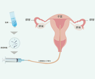 人工受孕過程及機率 妳懷孕了嗎？